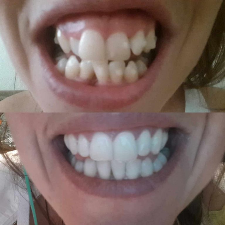 Invisalign Update 2 Years Of Wearing Braces Irish Travel Bloggers