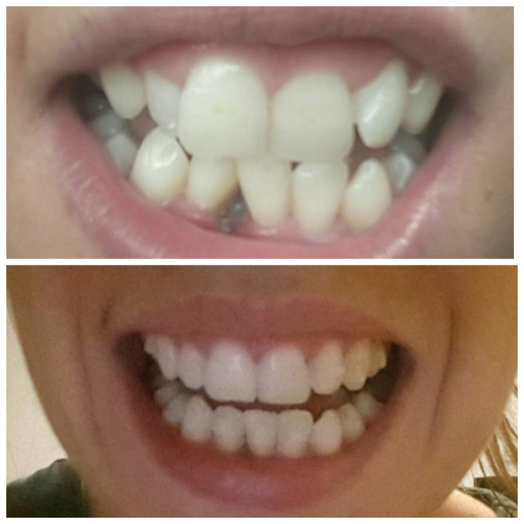 Invisalign Update 2 Years Of Wearing Braces Irish Travel Bloggers