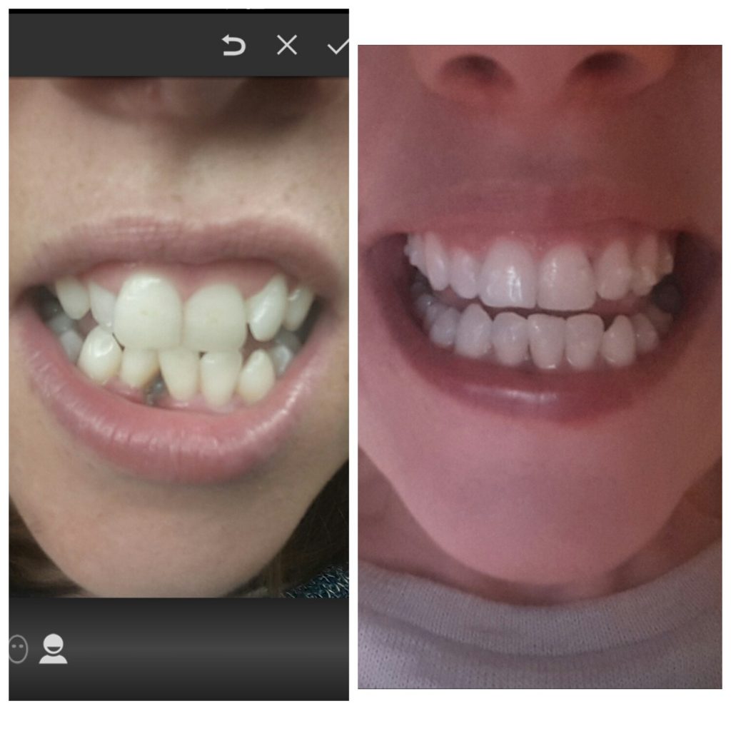 Invisalign Update 2 Years Of Wearing Braces Irish Travel Bloggers