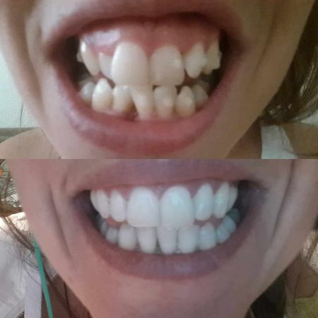 teeth after invisalign